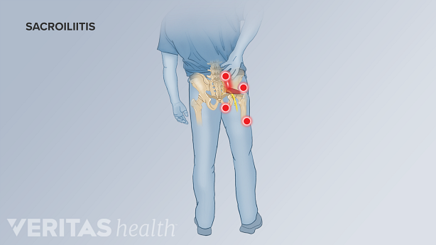 A man holding his back. Red dots highlight Sacroiliitis pain points.
