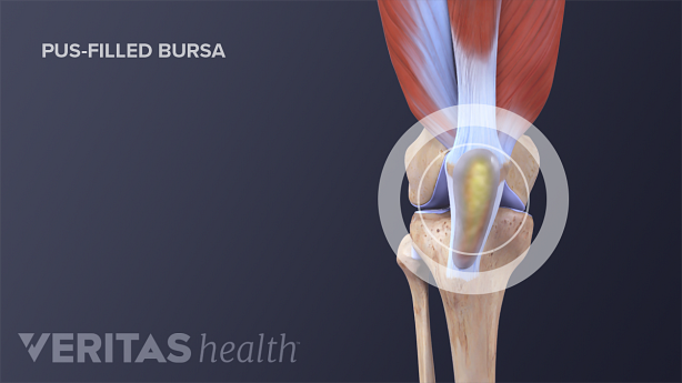 Medical illustration of infected knee bursa filled with pus