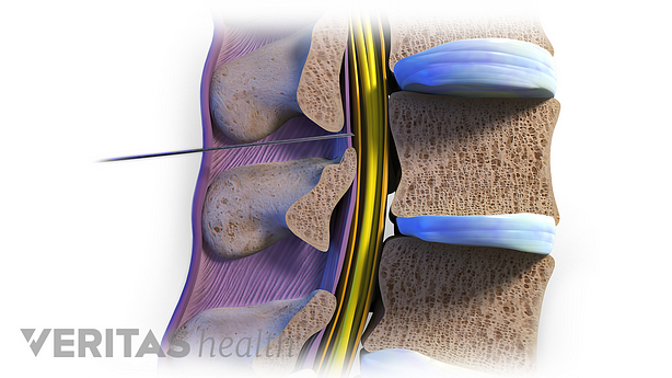 Vista sagital Ilustración de sección transversal 3D de una inyección epidural de esteroides lumbar.