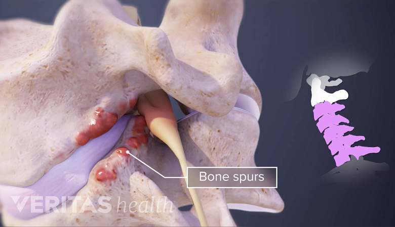 宫颈脊椎显示骨纹和宫颈脊柱以粉红色突出显示