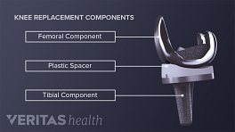 Front and side view of the components of a knee replacement. The following parts are labeled: Femoral component, plastic spacer, tibial component