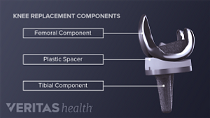 Front and side view of the components of a knee replacement. The following parts are labeled: Femoral component, plastic spacer, tibial component
