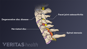 Medical illustration showing conditions that may occur in the cervical spine. Degenerative disc disease, facet joint osteoarthritis, herniated disc, and spinal stenosis are labeled.
