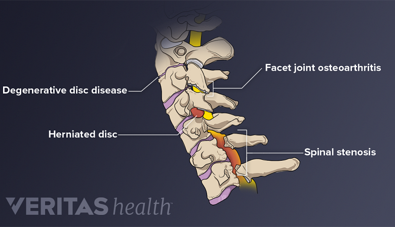 Illustration showing cervical spine showing degenerative disc disease, facet joint osteoarthritis, herniated disc, spinal stenosis.