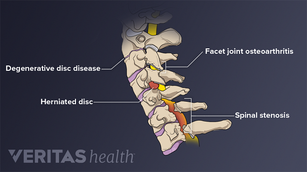 Ilustración médica de problemas comunes que afectan la columna cervical. Se destacan la enfermedad degenerativa del disco, la osteoartritis de las articulaciones facetarias, la hernia de disco y la estenosis espinal.