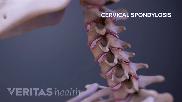 Medical illustration showing cervical spondylosis.