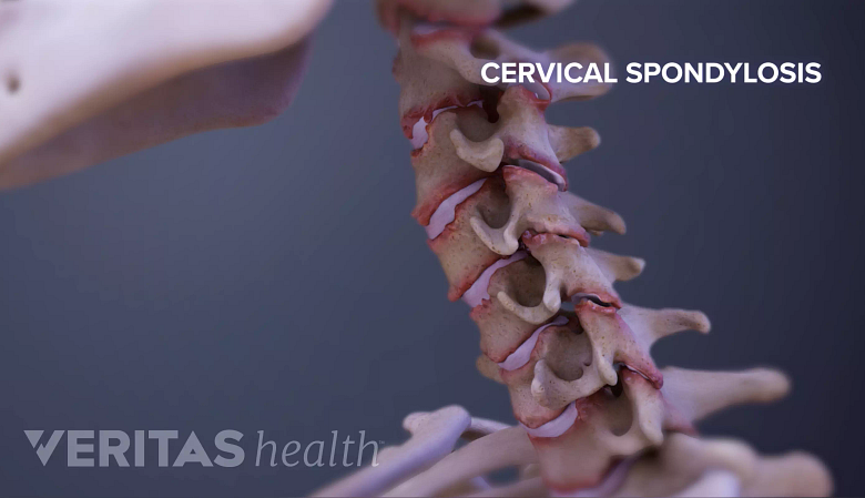 Medical illustration showing ankylosing spondylosois in the cervical spine.
