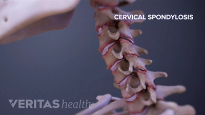 Profile view of spondylosis in between the vertebrae in the cervical spine.