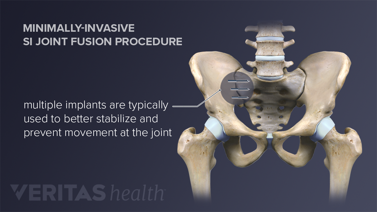How Sacroiliac Joint Fusion is Performed   Spine health