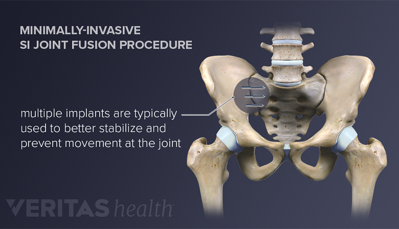 Minimally-Invasive SI Joint Fusion Procedure. Multiple implants are typically used to better stabilize and prevent movement at the joint.
