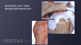 Rotator Cuff Surgery Recovery Tips