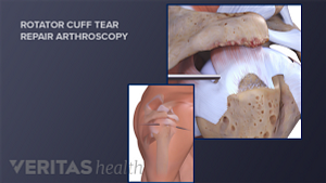 Arthroscopic procedure for a rotator cuff tear