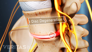 The disc between two vertebrae can degenerate and be compounded by diabetes.