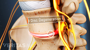 Sciatica pain caused by disc degeneration.