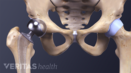 Medical illustration of a hip implant