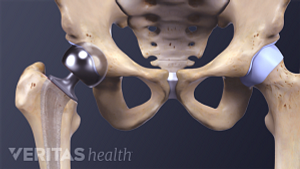 Medical illustration of a hip implant