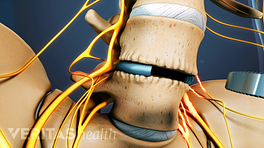 Anterior view of the ALIF procedure in the lumbar spine.
