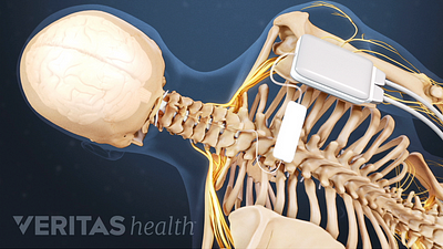 Medical illustration showing the placement of a spinal cord stimulator
