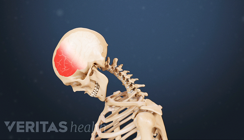 Illustration of a skeleton showing red area in the frontal region indicating concussion.