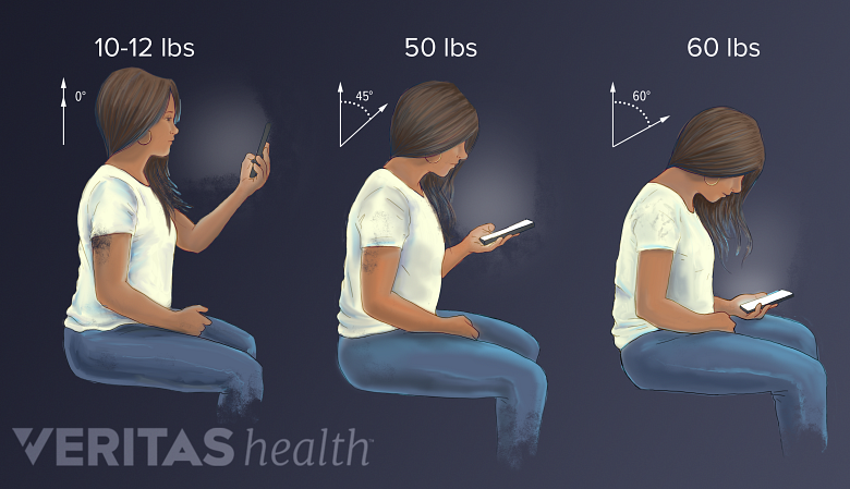 What is Tech Neck?, How Smartphones Affect You