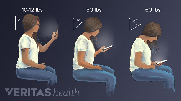 Views of posture in the neck when using a phone showing increase in pressure as you bend your neck.