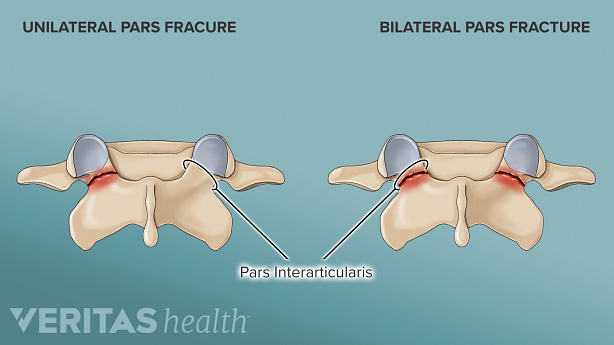 illustration showing fracture in pars.