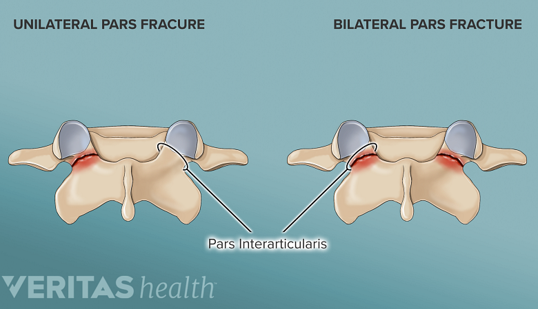 illustration showing fracture in pars.