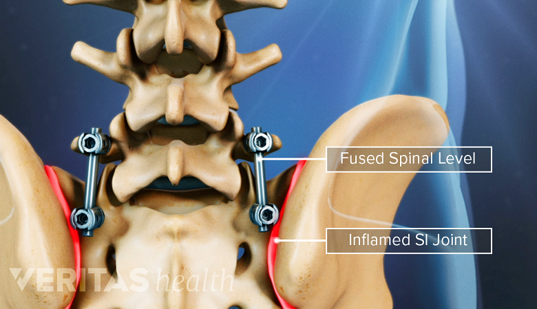 Illustration showing fused spinal level and inflamed SI joint.