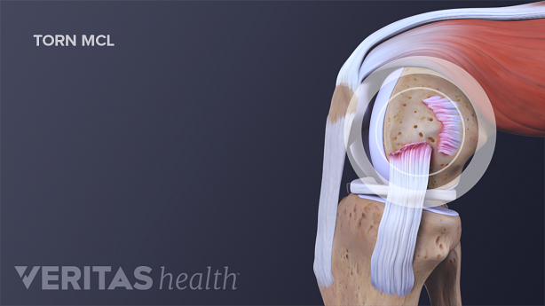 A torn medial collateral ligament (MCL)