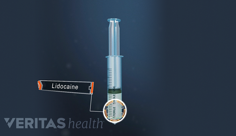 Syringe of lidocaine.