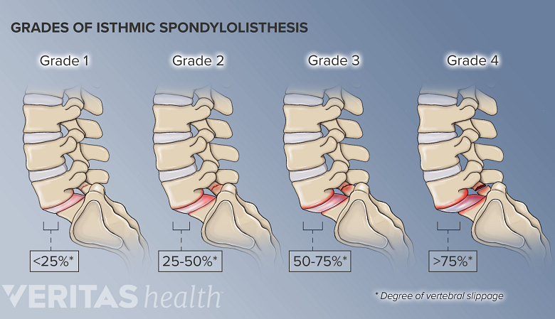 4 Varying degrees of spondylolisthesis of the L5-S1 segment from a sagittal view.
