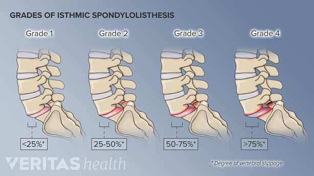 4 Varying degrees of spondylolisthesis of the L5-S1 segment from a sagittal view.