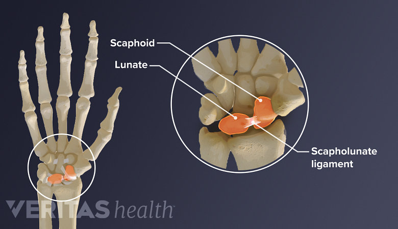 scapholunate ligament, scaphoid and lunate in the wrist