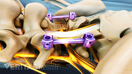 Posterior view of the lumbar spine showing screws and rods from fusion.