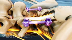 Screws used in posterior lumbar interbody fusion.