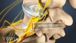 Two-step method patches herniated discs - Cornell Video