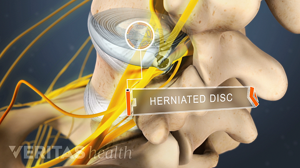 Superior, posterior view of a herniated disc in the lumbar spine.
