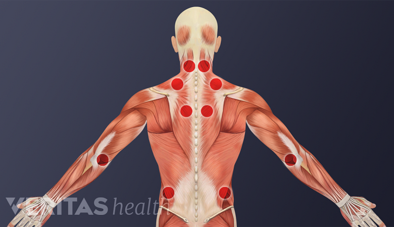 Illustration showing trigger points of myofacial pain syndrome.