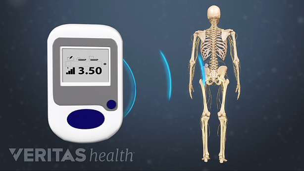 Wireless siganls transmitted from a spinal cord stimulator to the body.
