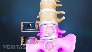 Una ilustración médica de las vértebras L5 y S1 de la espalda baja.