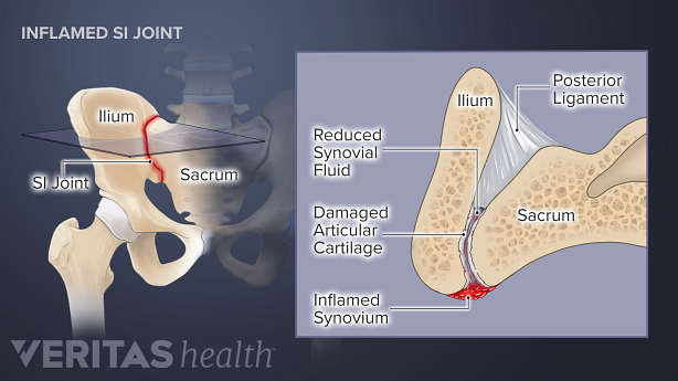 An illustration showing inflamed sarcoilliac joint.