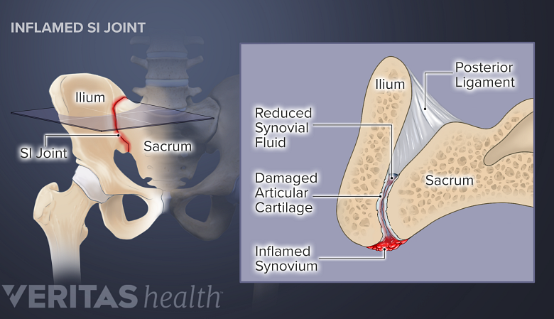An illustration showing inflamed sarcoilliac joint.
