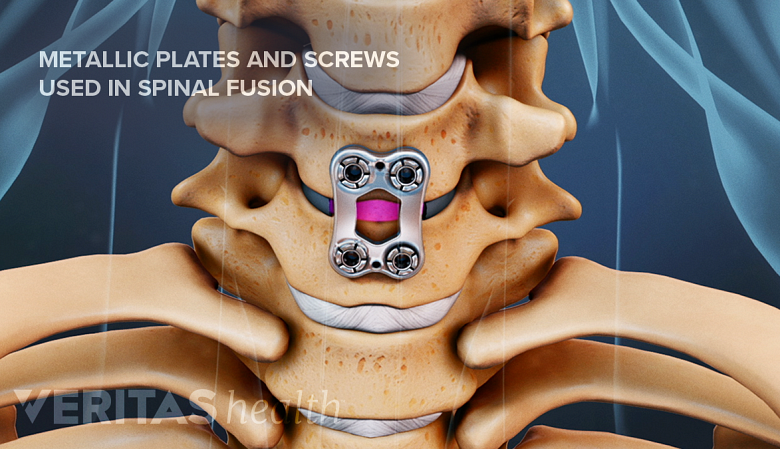 Illustration of cervical vertebra with metallic screws and plates.