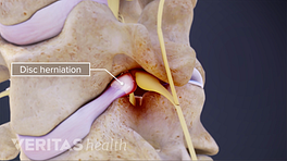 Medical illustration showing a cervical disc herniation