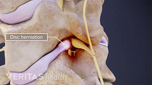 Medical illustration showing a cervical disc herniation