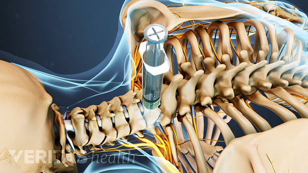 Posterior view of the upper back with a cervical injection in the cervical spine.