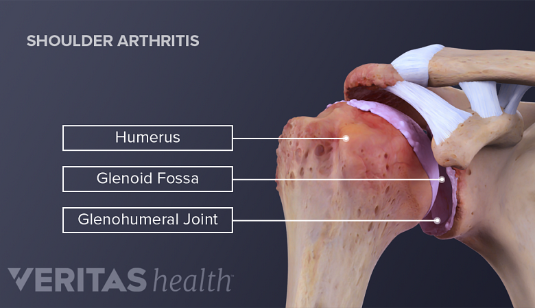 Illustration of shoulder joint anatomy with shoulder osteroarthrits.