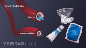 Illustration of the types of cold therapy and vasoconstricted blood vessels