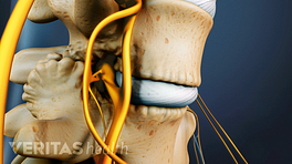 Medical illustration of two vertebrae showing bone spurs on the facet joints