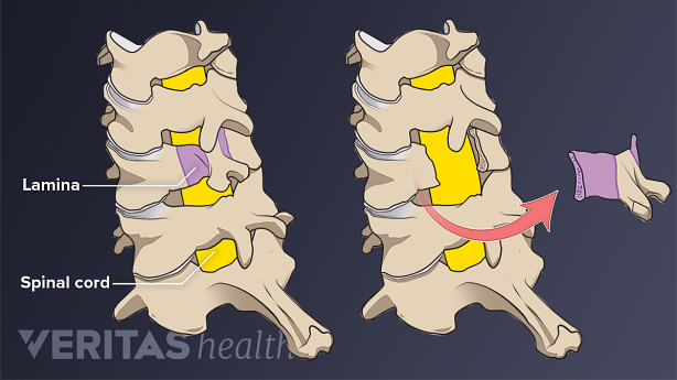 A medical illustration showing posterior laminectomy.